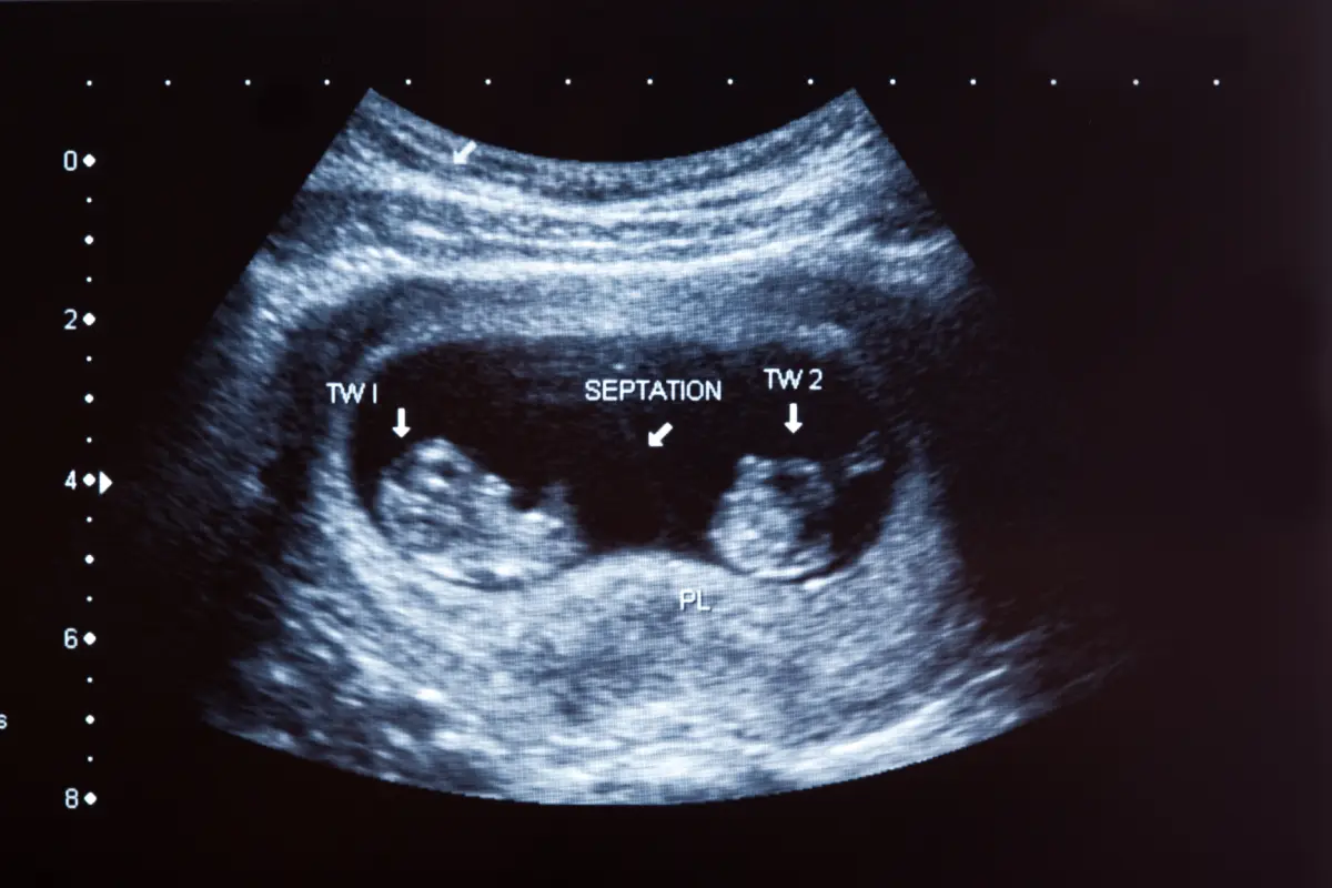 Échographie de jumeaux durant votre grossesse : tout comprendre